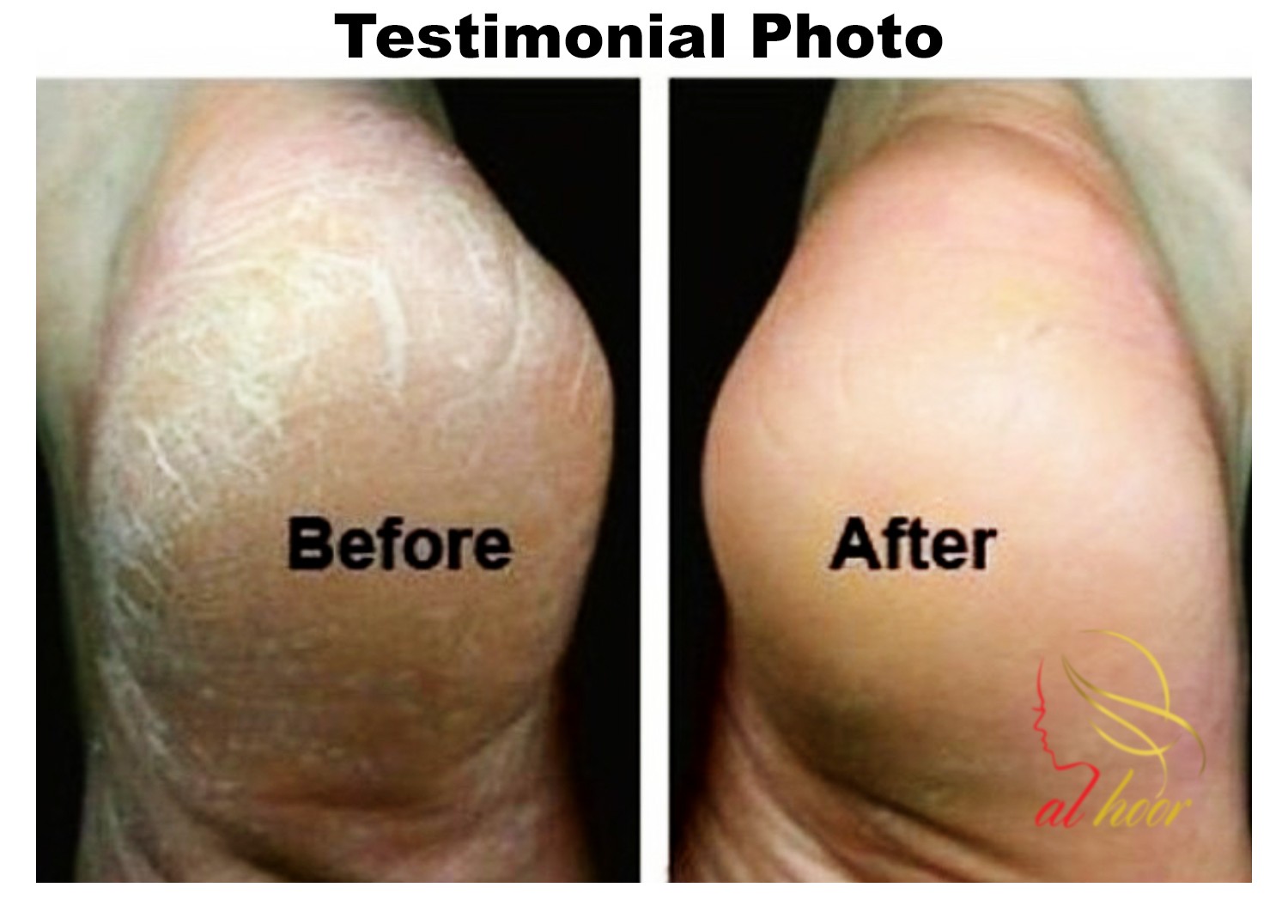 Restore Cracked Heels using Al Hoor Argan Oil treatment