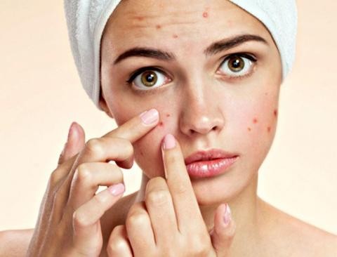 Treat Acne With Al Hoor Argan Oil