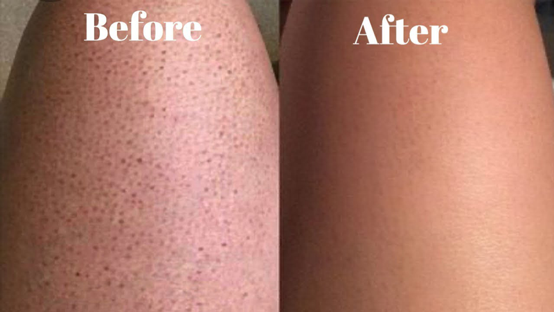 Strawberry Leg Treatment - Before and After