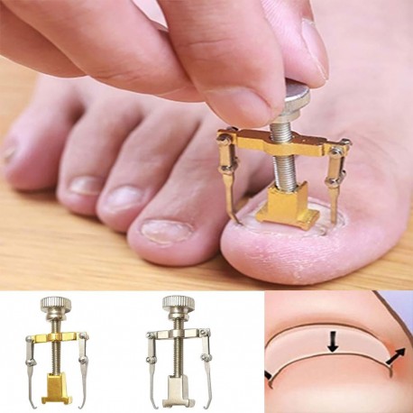 Ingrown Toenail Toe Fixer Recover Correction Device Pedicure 