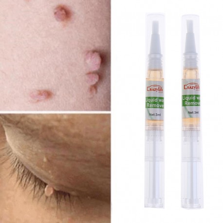 2pcs 5 Days Skin Tag Remover Pen Natural Health Mole Nevus Wart Skin Tag Foot Corn Warts Treatment Skin Tag Removal|Creams|   - 